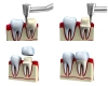 دانلود تصویر کیفیت بالای لمینت دندان به صورت سه بعدی