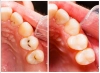 دانلود تصویر کیفیت قبل و بعد دندان خراب
