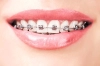 عکس باکیفیت ارتودنسی دندان سه بعدی 